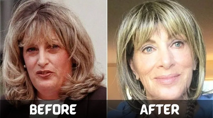 Linda Tripp Before and After Surgery